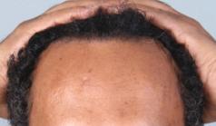 Before Hair Transplant&nbsp;Hairlines